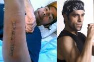 Sandeep Sachdev fractures his hand in a freaky road accident